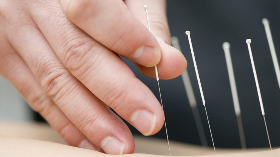 exploring the benefits of dry needling