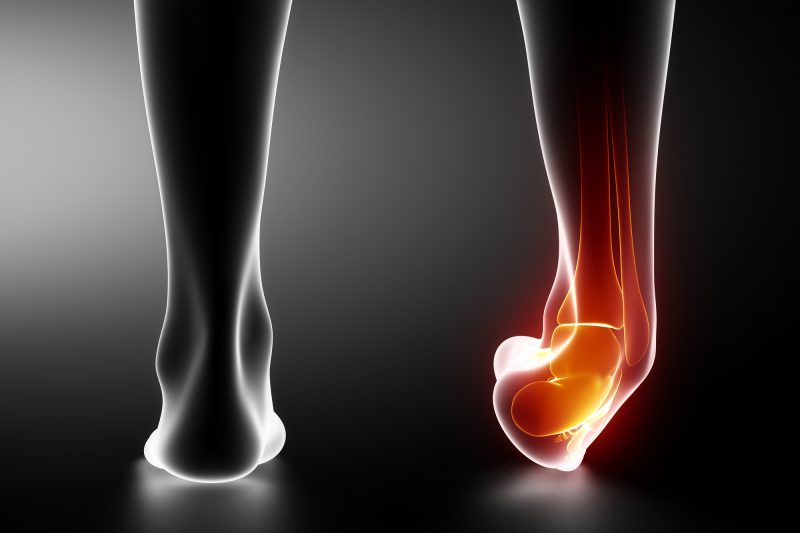 lateral ankle sprain